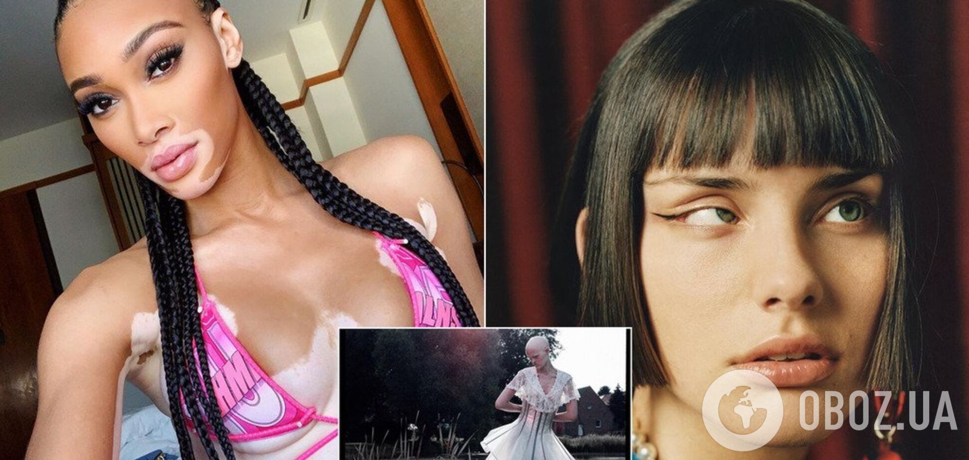 Необычная красота: пять самых известных моделей с редкими заболеваниями