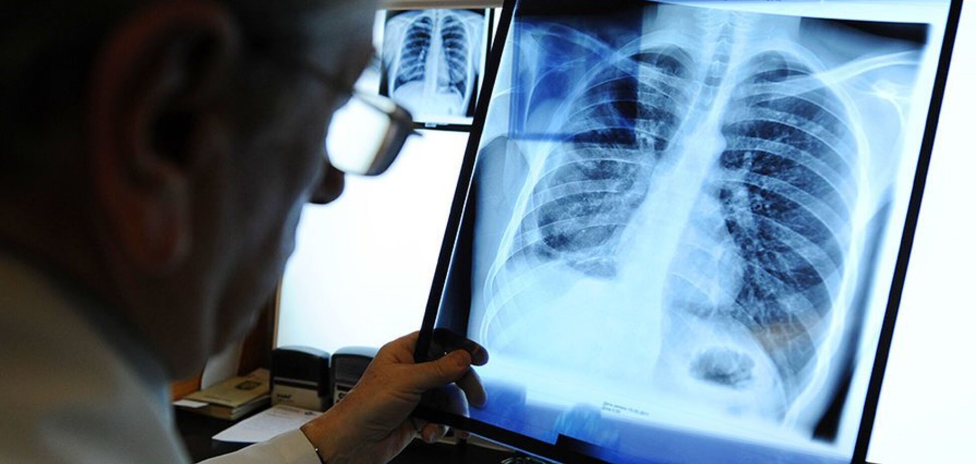 'Рискуем перешагнуть эпидпорог туберкулеза': медики обратились к Зеленскому