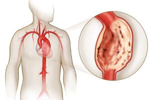 Аневризма сердца: причины возникновения и основные симптомы, способы лечения заболевания