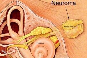 Невринома слухового нерва: причины возникновения и основные симптомы, способы лечения заболевания