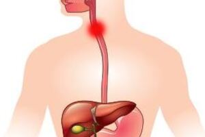 Ахалазия пищевода: причины возникновения и основные симптомы, способы лечения заболевания