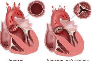 Аортальный стеноз: причини виникнення та основні симптоми, способи лікування захворювання