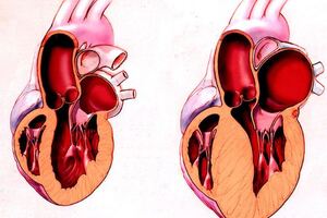 Гипертрофическая кардиомиопатия: причины возникновения и основные симптомы, способы лечения заболевания