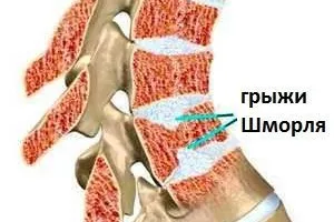 Грыжа Шморля (узлы Шморля): причины возникновения и основные симптомы, способы лечения заболевания