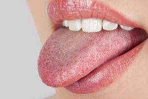 Воспаление языка: причины возникновения и основные симптомы, способы лечения заболевания