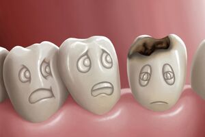 Кариес зубов: причины возникновения и основные симптомы, способы лечения заболевания