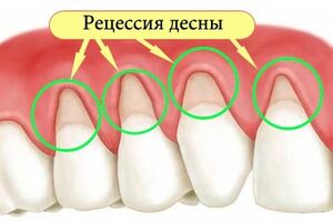 Рецессия десны: причины возникновения и основные симптомы, способы лечения заболевания