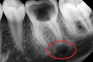Киста зуба: причины возникновения и основные симптомы, способы лечения заболевания