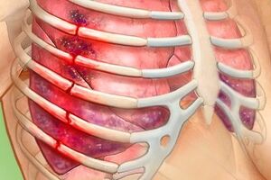 Перелом ребра: причины возникновения и основные симптомы, способы лечения заболевания