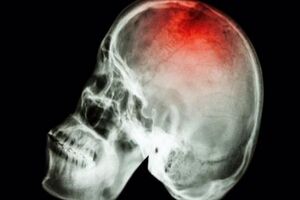 Перелом черепа: причины возникновения и основные симптомы, способы лечения заболевания