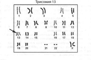 Трисомия 13: причини виникнення та основні симптоми, способи лікування захворювання