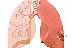 Абсцедирующая пневмония: причины возникновения и основные симптомы, способы лечения заболевания