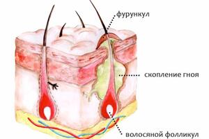 Фурункул: причини виникнення та основні симптоми, способи лікування захворювання