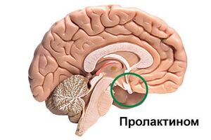 Пролактинома: причины возникновения и основные симптомы, способы лечения заболевания