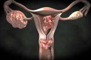 Аденокарцинома матки: причини виникнення та основні симптоми, способи лікування захворювання