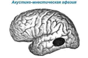 Акустико-гностическая афазия: причини виникнення та основні симптоми, способи лікування захворювання