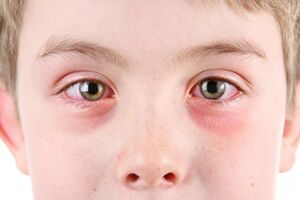 Аллергический кератит: причины возникновения и основные симптомы, способы лечения заболевания