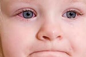 Аллергический конъюнктивит у детей: причини виникнення та основні симптоми, способи лікування захворювання