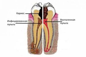 Пульпит: причины возникновения и основные симптомы, способы лечения заболевания