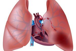 Артериовенозная аневризма легких: причины возникновения и основные симптомы, способы лечения заболевания