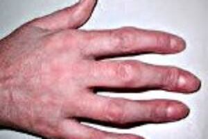 Артрит пальцев: причины возникновения и основные симптомы, способы лечения заболевания