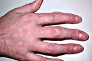 болезнь суставов рук, как лечить inflamația țesuturilor periarticulare ale articulației genunchiului