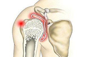 Артрит плечевого сустава: причини виникнення та основні симптоми, способи лікування захворювання