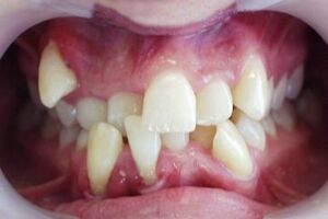 Аномалии зубных рядов: причины возникновения и основные симптомы, способы лечения заболевания