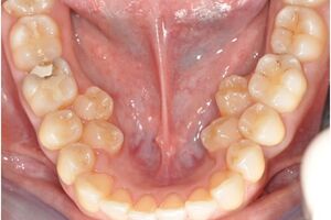 Аномалии зубов: причини виникнення та основні симптоми, способи лікування захворювання