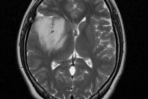 Астроцитома головного мозга: причини виникнення та основні симптоми, способи лікування захворювання