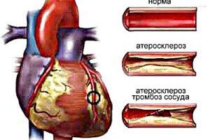 Атеросклеротический кардиосклероз: причины возникновения и основные симптомы, способы лечения заболевания