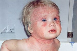 Атопический дерматит у детей: причины возникновения и основные симптомы, способы лечения заболевания