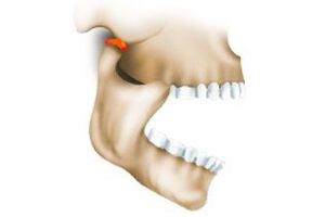 Анкилоз ВНЧС (височно-нижнечелюстного сустава): причины возникновения и основные симптомы, способы лечения заболевания