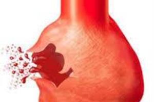 Аневризма брюшной аорты: причины возникновения и основные симптомы, способы лечения заболевания