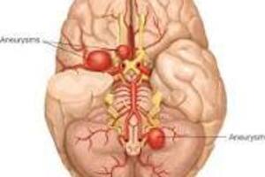 Аневризмы сосудов головного мозга: причины возникновения и основные симптомы, способы лечения заболевания