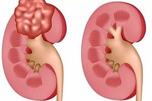 Ангиолипома почки: причины возникновения и основные симптомы, способы лечения заболевания