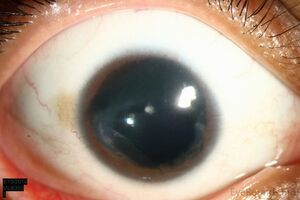 Аномалии развития глаза: причини виникнення та основні симптоми, способи лікування захворювання