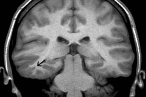 Аномалии развития головного мозга: причины возникновения и основные симптомы, способы лечения заболевания