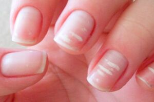 Білі плями на нігтях: причини виникнення та основні симптоми, способи лікування захворювання