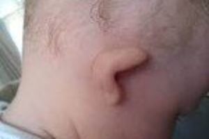 Аномалии развития ушной раковины: причини виникнення та основні симптоми, способи лікування захворювання