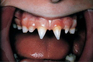 Аномалии формы зубов: причины возникновения и основные симптомы, способы лечения заболевания