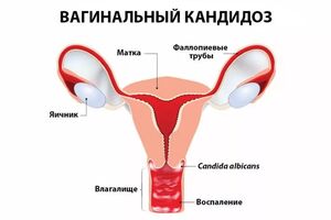 Вагинальный кандидоз: причины возникновения и основные симптомы, способы лечения заболевания