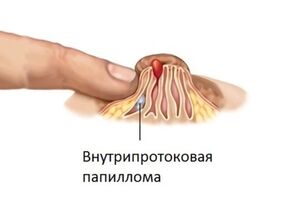 Внутрипротоковая папиллома молочной железы: причини виникнення та основні симптоми, способи лікування захворювання