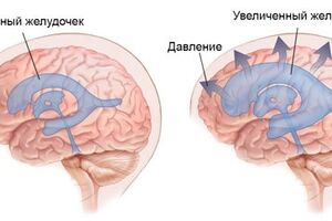 Внутричерепная гипертензия: причины возникновения и основные симптомы, способы лечения заболевания