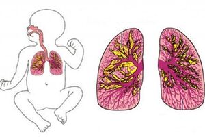 Внутриутробная пневмония: причины возникновения и основные симптомы, способы лечения заболевания