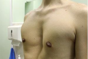 Воронкообразная грудная клетка: причини виникнення та основні симптоми, способи лікування захворювання