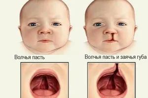Волчья пасть: причини виникнення та основні симптоми, способи лікування захворювання