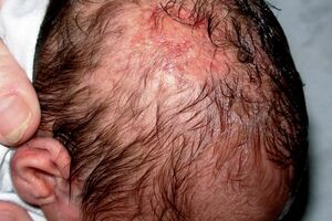 Врожденная аплазия кожи: причини виникнення та основні симптоми, способи лікування захворювання