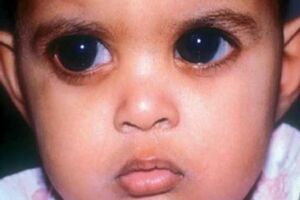 Врожденная глаукома: причини виникнення та основні симптоми, способи лікування захворювання