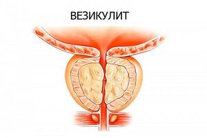 Везикулит: причины возникновения и основные симптомы, способы лечения заболевания